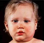 Bebeklerde Tükürük Bezi İltihabı Belirtileri ve Tedavisi