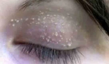 Küçük Yağ Bezesi Belirtileri ve Tedavisi