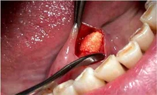 Tükürük Bezi İltihabı Belirtileri ve Tedavisi