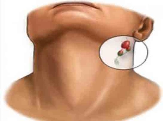 Lenf Bezi İltihabı Belirtileri ve Tedavisi