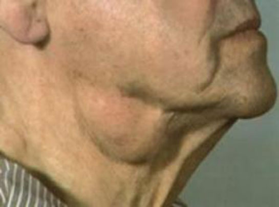 Boğazda Yağ Bezesi Belirtileri ve Tedavisi