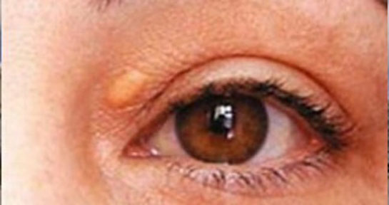 Göz Üstünde Yağ Bezesi Belirtileri ve Tedavisi