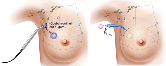 Koltuk Altı Beze Belirtileri ve Tedavisi