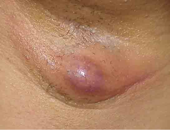 Koltuk Altı Lenf Bezi Şişmesi Belirtileri ve Tedavisi