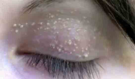 Küçük Yağ Bezesi Belirtileri ve Tedavisi