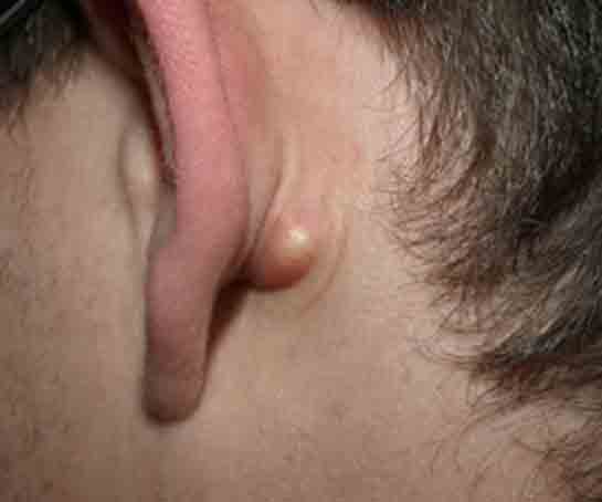 Kulak Arkası Beze Belirtileri ve Tedavisi