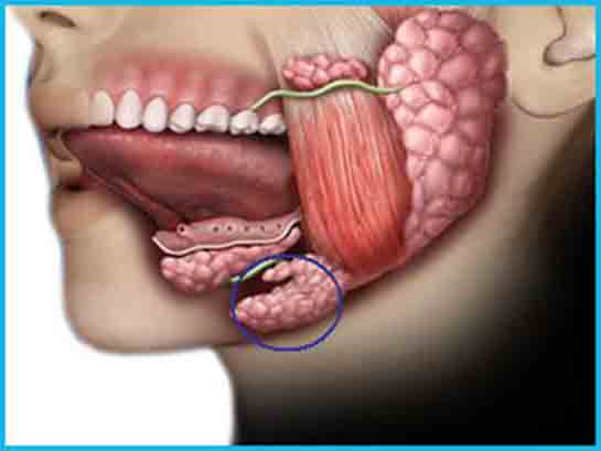 Parotis Bezi Tümörü Belirtileri ve Tedavisi