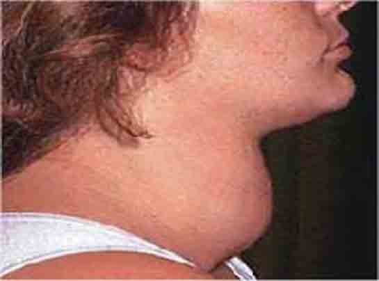 Tiroid Bezi Büyümesi Belirtileri ve Tedavisi