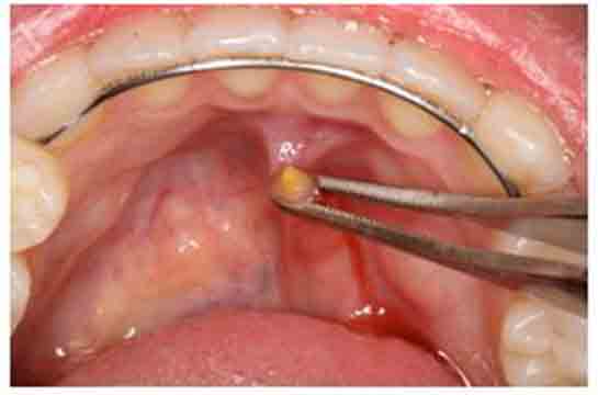 Tükürük Bezi Taşı Kullanımı ve Faydaları Nelerdir?