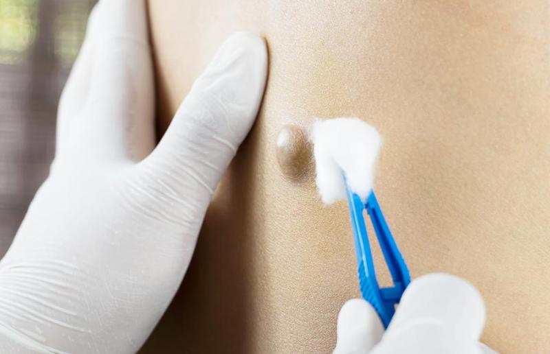 Yağ Bezesi Ameliyatı Riskleri ve Sonrası